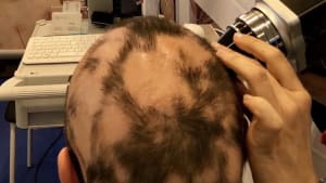 Early treatment to prevent Alopecia Areata Progression