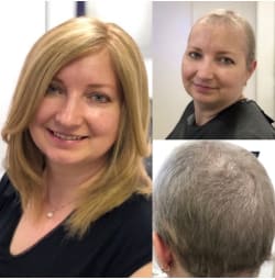 What is a Hair Replacement System? | Alopecia UK