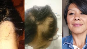 Tanya tells us about her experience with alopecia