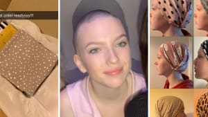 Turning alopecia into an opportunity
