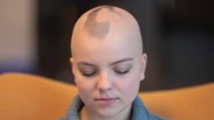 New Survey Exploring the Social and Economic Impact of Alopecia Areata