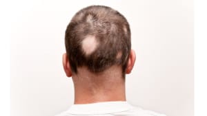 A clinical trial to test a new topical treatment for alopecia areata